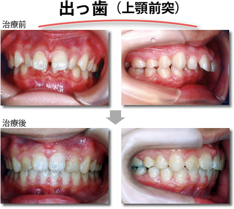 出っ歯