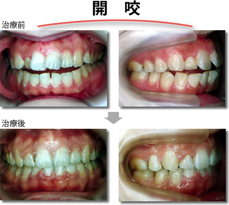 矯正治療例
