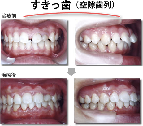 矯正治療例
