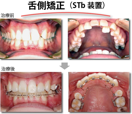矯正治療例