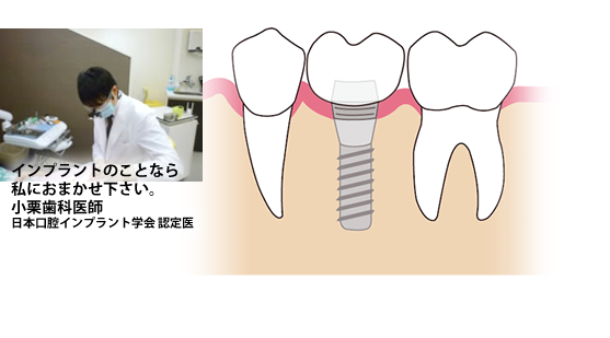 インプラント治療